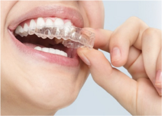 マウスピース型矯正装置（インビザライン）